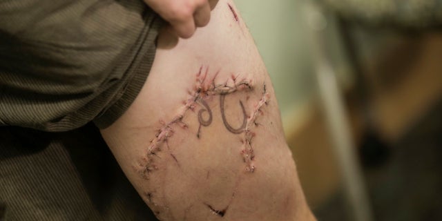 Joseph Tanner displaying his scars.