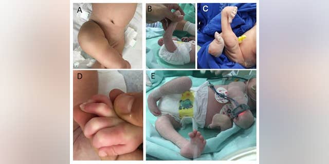 arthrogryposis BMJ