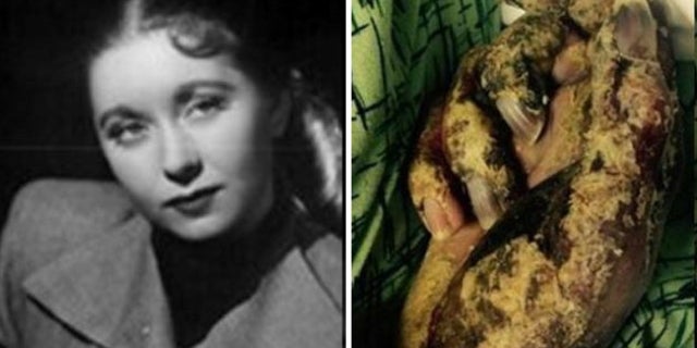 Rebecca Zeni, a former model, died of a scabies infestation while in the care of a Georgia nursing home.