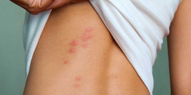 Bugs can bite through almost any surface of the skin.