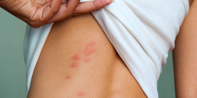 Bugs can bite through almost any surface of the skin.