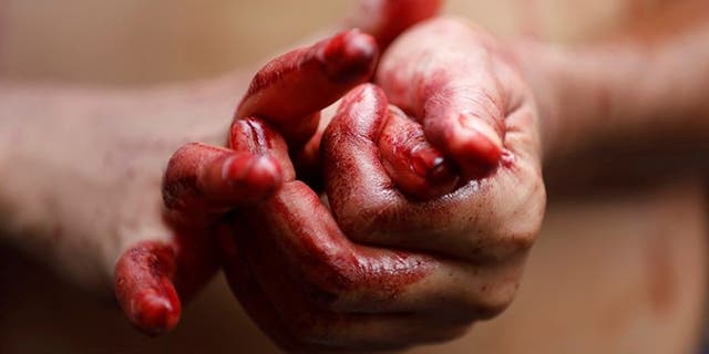 A woman (not pictured) was hospitalized for spontaneously "sweating blood" from her face and palms of her hands, a case report revealed.