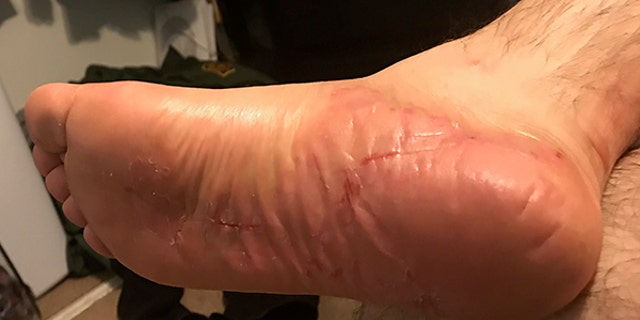 A US Border Patrol agent suffered chemical burns through his boots and uniform after he chased down a fugitive in the Tijuana Valley area.