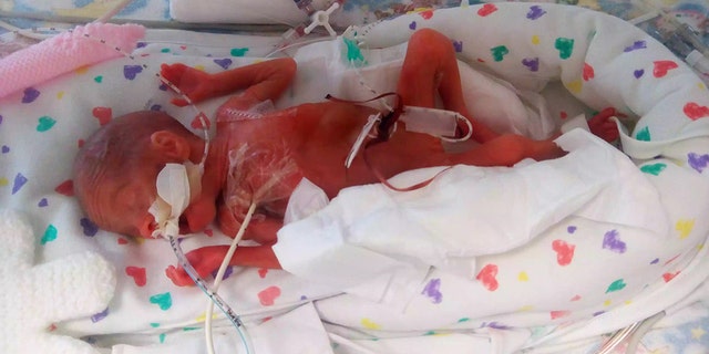 Hallie's skin did not have time to develop the pigmentation in the later stages of pregnancy and her skull was not fully developed.