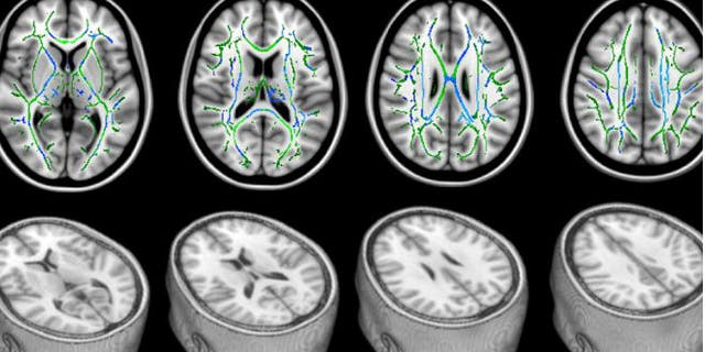 In these DTI scans, the bottom row shows views of a head with the top sliced away to reveal the brain. The top row shows the corresponding top views of the brain. The green lines represent the white matter— the brain’s “wiring.” The blue areas are the damaged parts of the white matter that seem to be responsible for cognitive problems experienced by study patients with mild traumatic brain injury. (Professor Blamire/Newcastle University, UK)
