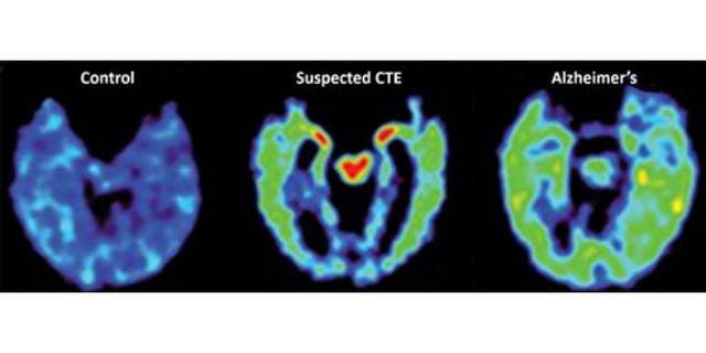 This combination of PET scans provided by UCLA on April 2, 2015 shows, from left, a normal brain scan, a suspected Chronic Traumatic Encephalopathy (CTE) subject, and a subject with Alzheimer's disease. (AP Photo/PNAS/David Geffen School of Medicine at UCLA)
