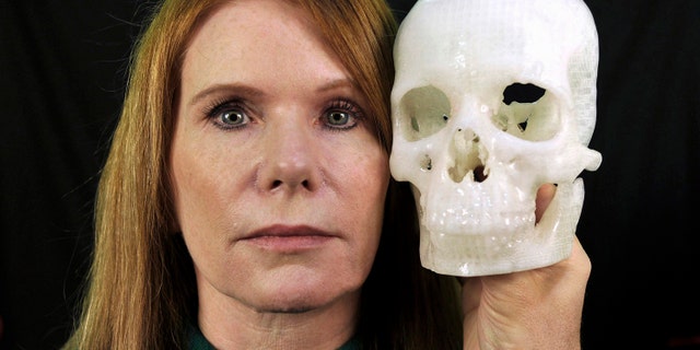In this photo taken Jan. 13, 2015, Pamela Shavaun Scott holds a 3D printer model of her skull after her brain tumor was removed from behind her eye, in Morro Bay, Calif. (AP Photo/Phil Klein)