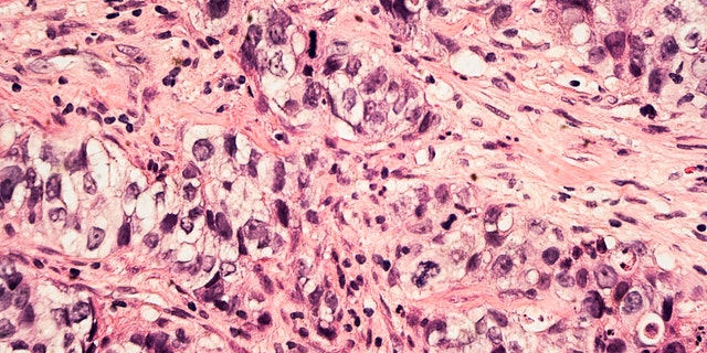 breast cancer graphic istock large