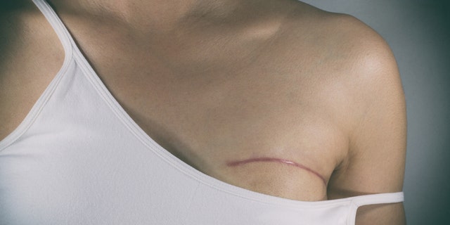 Breast cancer surgery scars by partial mastectomy. With effect filter.