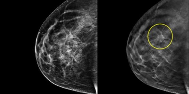 Image taken using conventional mammography and an image using 3D, with a tumor circled that wasn't visible before.