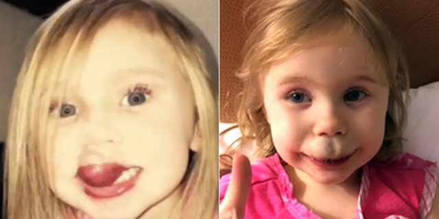 Brianna Brewer, 3, is pictured before her surgery, left, and during recovery, right.
