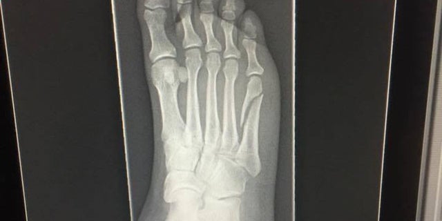 Diana Vadala said she broke her foot while celebrating the Patriots win.
