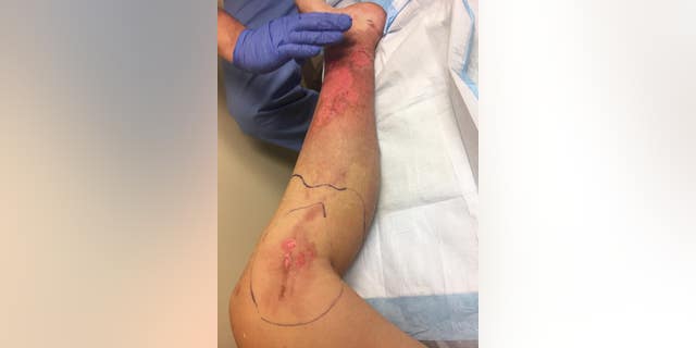 A photo of Murphy's leg after the blisters were drained.