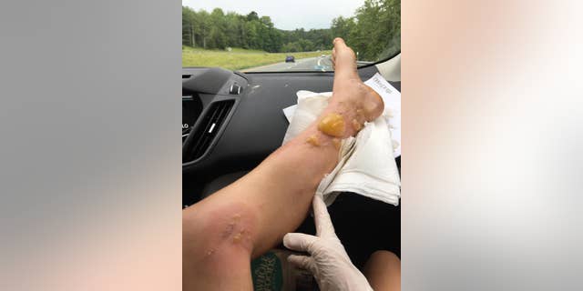Murphy said she had trouble walking before she was treated for the blisters.