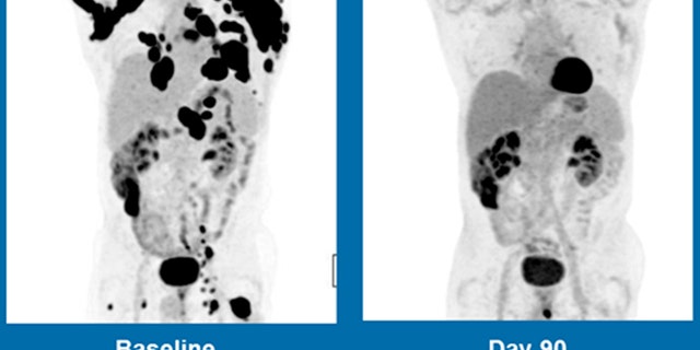 These scans show a 62-year-old man with non-Hodgkin lymphoma, at left in Dec. 2015, and three months after treatment with Kite Pharma's experimental gene therapy.