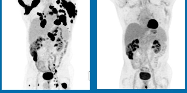 These scans show a 62-year-old man with non-Hodgkin lymphoma, at left in Dec. 2015, and three months after treatment with Kite Pharma's experimental gene therapy.