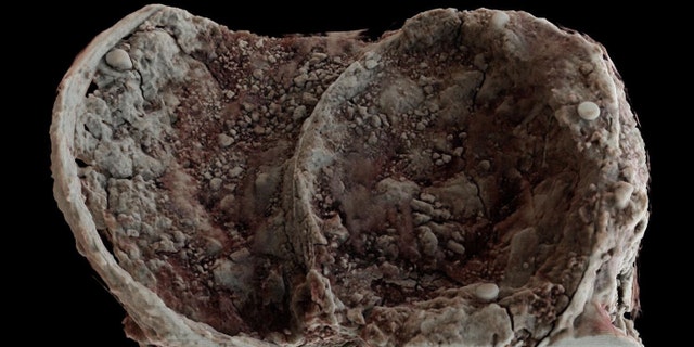 Iron Age cauldron discovered at Glenfield Park, Leicestershire (University of Leicester).