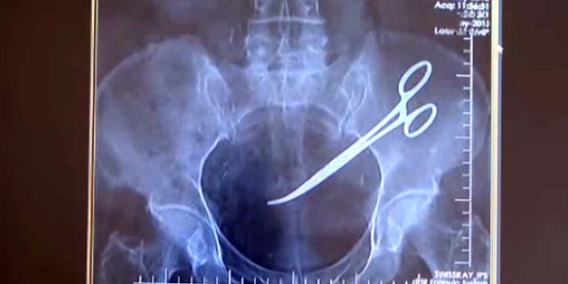 A Turkish woman was shocked to learn doctors had left scissors in her abdomen after surgery