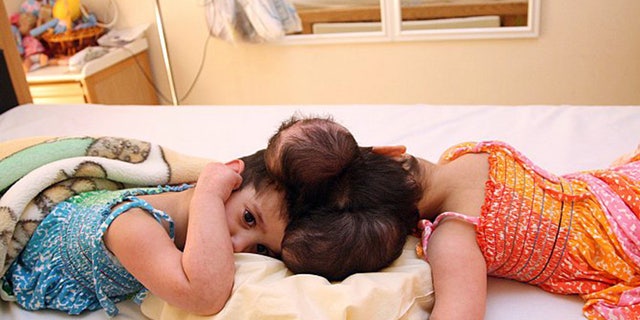Tuqa and Yakeen are said to be doing well after a 10-hour surgery to separate them.
