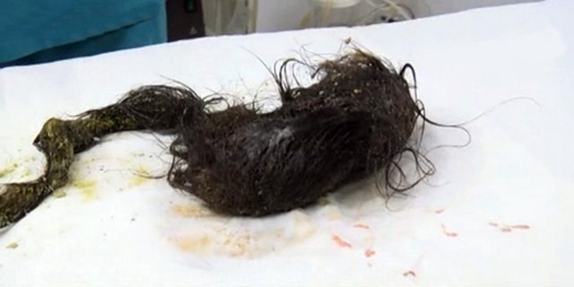 The 11-year-old, from Taraz, in southern Kazakhstan, consumed so much hair from her own head that the mass filled nearly 7 inches of her stomach and continued about 14 inches into her bowel.