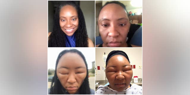Texas woman's face swells after allergic reaction to hair dye | Fox News Texas woman's face swells after allergic reaction to hair dye | Fox News