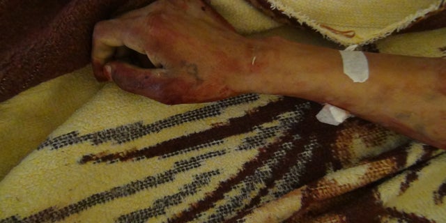 A Kurdish victim of a reported ISIS attack in Syria, in 2014.