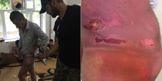 Fighters on the front lines had no protective gear, according to Tony Schiena, shown above inspecting the wounds of a Kurdish fighter.