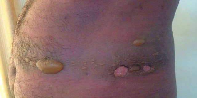 Medical experts say these yellow blisters are a sure symptom of chemical weapons poisoning.