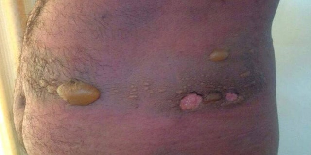 Medical experts say these yellow blisters are a sure symptom of chemical weapons poisoning.