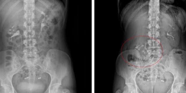 In the scan on the left, taken when the woman was lying down, her kidneys appear at the same level on both sides of her spine. In the scan on the right, taken when the woman was standing upright, her right kidney (circled on the left in the scan) falls into the pelvis.