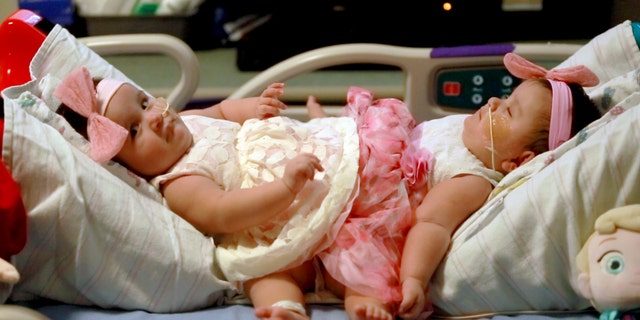 Feb. 10, 2016: This photo provided by Driscoll Children's Hospital shows conjoined twin sisters Scarlett, left, and Ximena Hernandez-Torres at Dirscoll Children's Hospital in Corpus Christi, Texas.