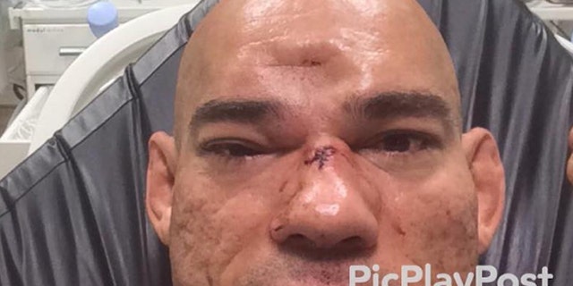 Evangelista "Cyborg" Santos suffered a skull fracture in last week's bout.