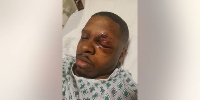 Rasaan Urquhart, 25, is warning others to be safe around fireworks on the Fourth after going blind in one eye after an incident in February.