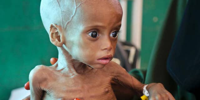 FILE -- In this March 11, 2017 file photo a malnourished child is treated at the Banadir Hospital in Mogadishu, Somalia. In a report released by Oxfam at the World Economic Forum in Durban, South Africa, Wednesday, May 3, 2017 it said that Africa has higher levels of poverty than previously thought because decades of economic growth have only benefited a small elite. (AP Photo/Mohamed Sheikh Nor, File)