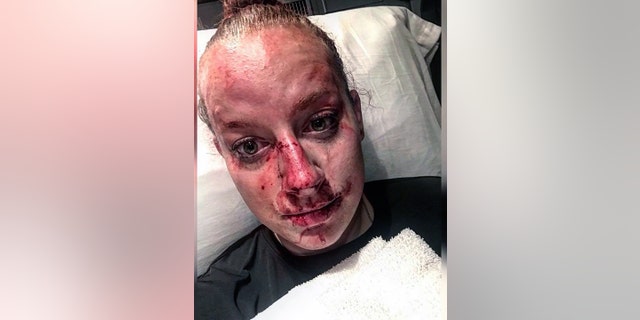 Brooke County (W.Va.) Sheriff's Deputy Kristen Richmond posted this photo of her injuries after a fight with a suspect early Friday.