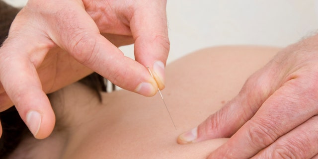 acupunctură