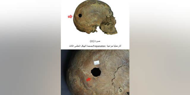 A hole has been made in one of the skulls, the result of trepanation, or trepanning, a surgical procedure that dates back thousands of years. (Egyptian Ministry of Antiquities)