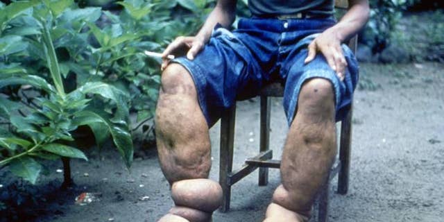This CDC photo, from 1962, shows a man in the Philippines with elephantiasis of the lower limbs.