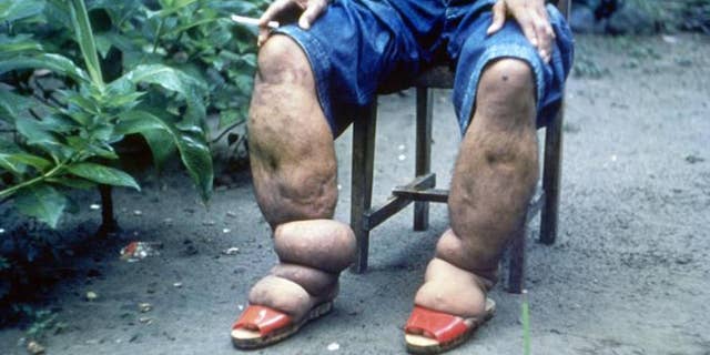 This CDC photo, from 1962, shows a man in the Philippines with elephantiasis of the lower limbs.