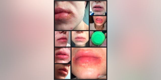 Users claim EOS lip balm left their lips cracked and flaky.