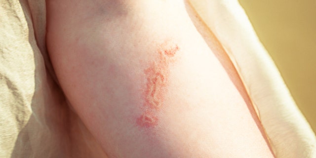 Jellyfish may look harmless but one sting may have you staying away from the ocean for awhile.