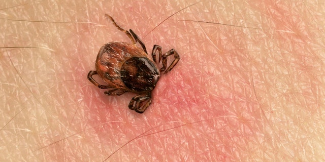 Tick with its head sticking in human skin, red blotches indicate an infection
