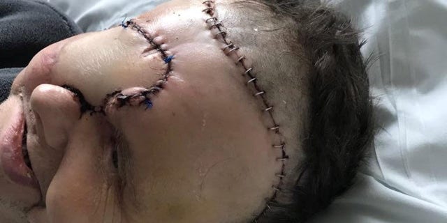 The former gardener's weak state has left doctors with no choice but to fashion a “flap” using skin from his back and an artery in his leg to cover the hole in his face.