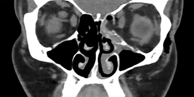 A CT scan of the woman's face shows the orbital fracture on the right side of the image (her left side). Normally, air (which appears black in the scan) should fill the sinus cavities, but the fracture allowed fat (shown in gray) to leak into the cavity on the right side of the image.