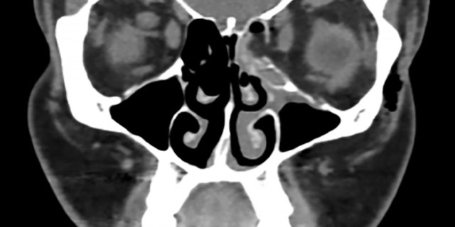 A CT scan of the woman's face shows the orbital fracture on the right side of the image (her left side). Normally, air (which appears black in the scan) should fill the sinus cavities, but the fracture allowed fat (shown in gray) to leak into the cavity on the right side of the image.
