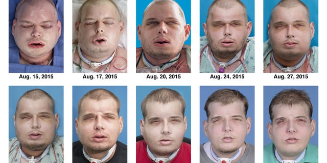 This combination of Aug. 15, 2015 to Nov. 11, 2015 photos provided by the New York University Langone Medical Center shows the recuperation of Patrick Hardison after his facial transplant surgery in New York. Hardison was burned Sept. 5, 2001, in Senatobia, Miss. A 27-year-old father of three at the time who'd served for seven years as a volunteer firefighter, he entered a burning house to search for a woman. The roof collapsed, giving him third-degree burns on his head, neck and upper torso. (Mary Spano/Eduardo D. Rodriguez/Wyss Department of Plastic Surgery/NYU Langone Medical Center via AP)