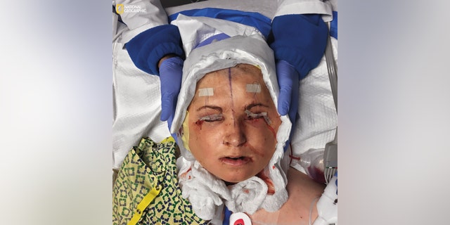 A surgical resident carefully cradles Katie’s head to keep it still as she’s situated in the intensive care unit after the 31-hour procedure concluded. To protect her eyes, her eyelids were sutured shut.