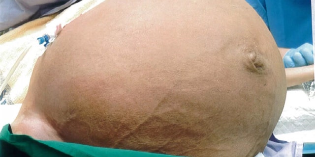 The patient, located in Singapore, may have avoided going to the doctor as the fibroid grew over a fear of surgery.