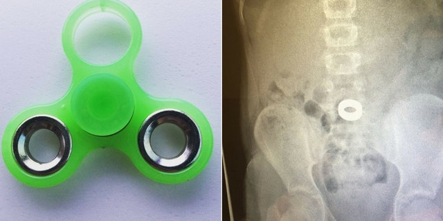 The Indiana girl was playing with her fidget spinner when a metal piece flew off and went into her mouth. (Decatur Township Fire Department)
