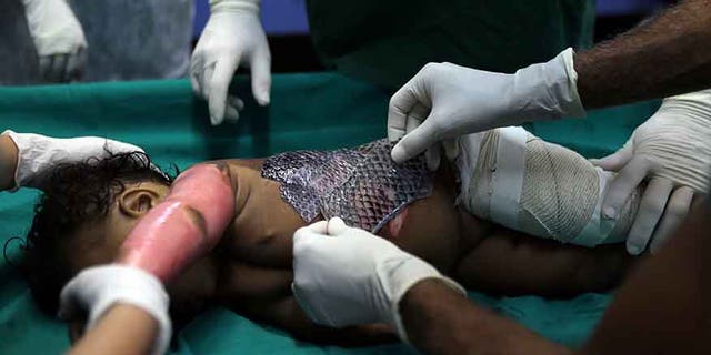 do doctors use fish skin on burn victims